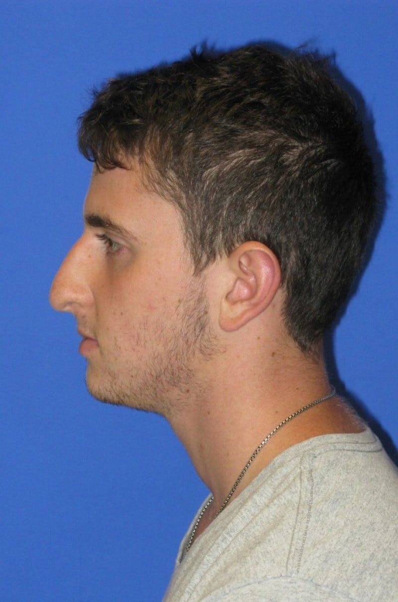 Rhinoplasty Before & After Gallery - Patient 128792 - Image 3