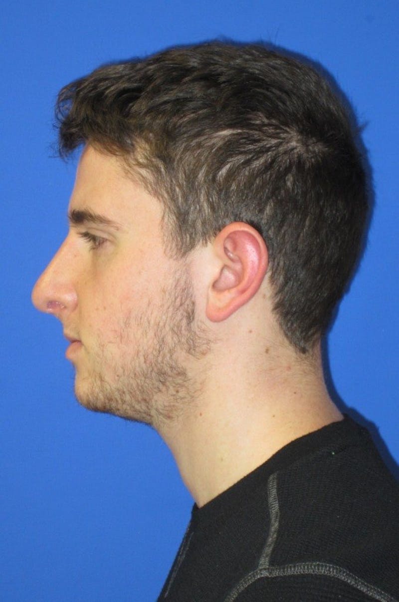 Rhinoplasty Before & After Gallery - Patient 128792 - Image 4