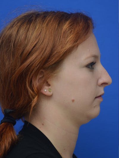 Rhinoplasty Before & After Gallery - Patient 389378 - Image 1