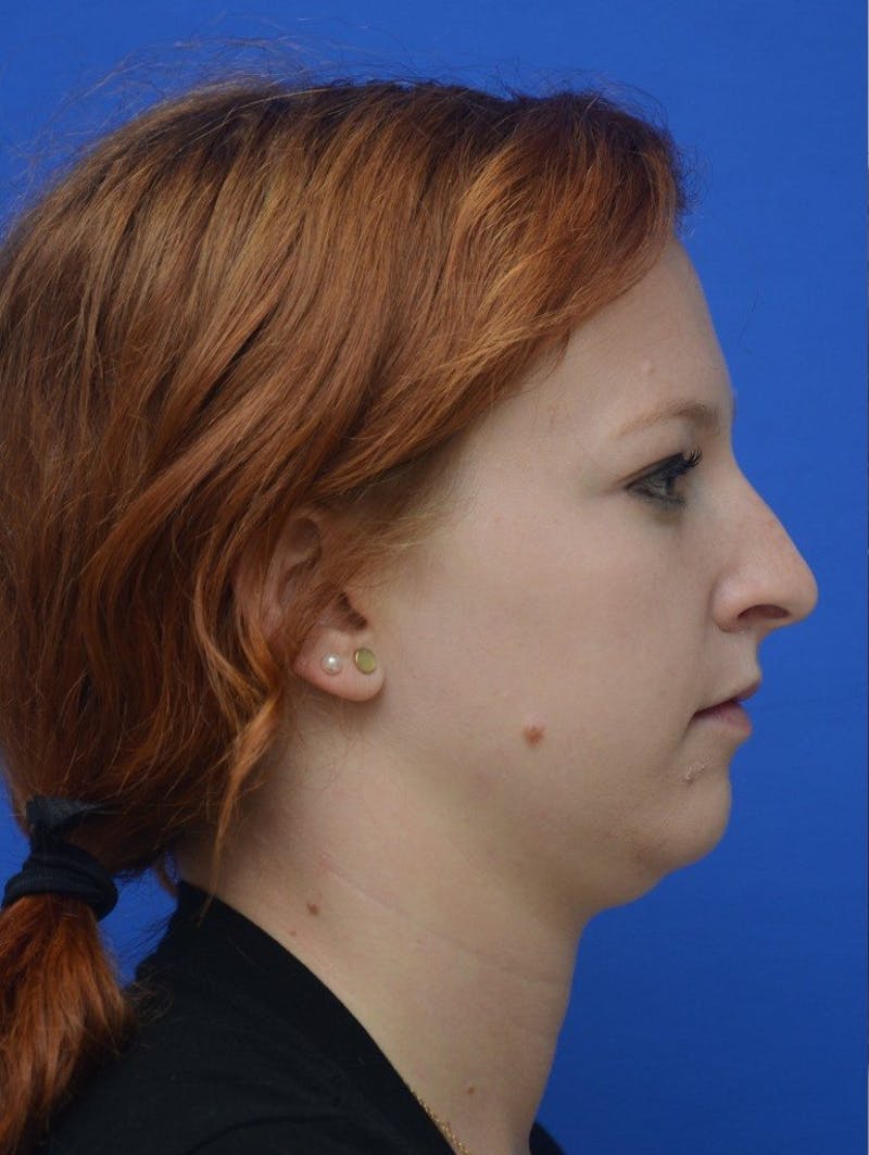 Rhinoplasty Before & After Gallery - Patient 389378 - Image 1