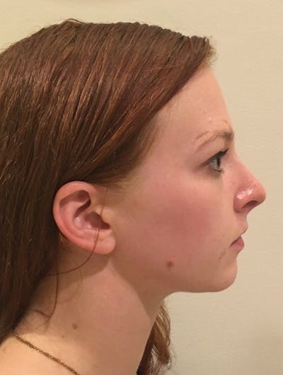 Rhinoplasty Before & After Gallery - Patient 389378 - Image 2