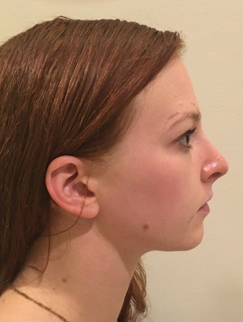 Rhinoplasty Before & After Gallery - Patient 389378 - Image 2