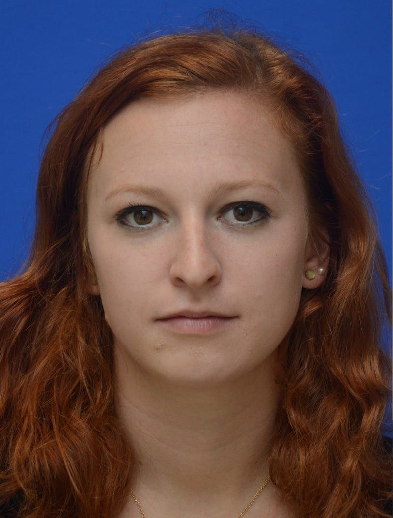 Rhinoplasty Before & After Gallery - Patient 389378 - Image 3