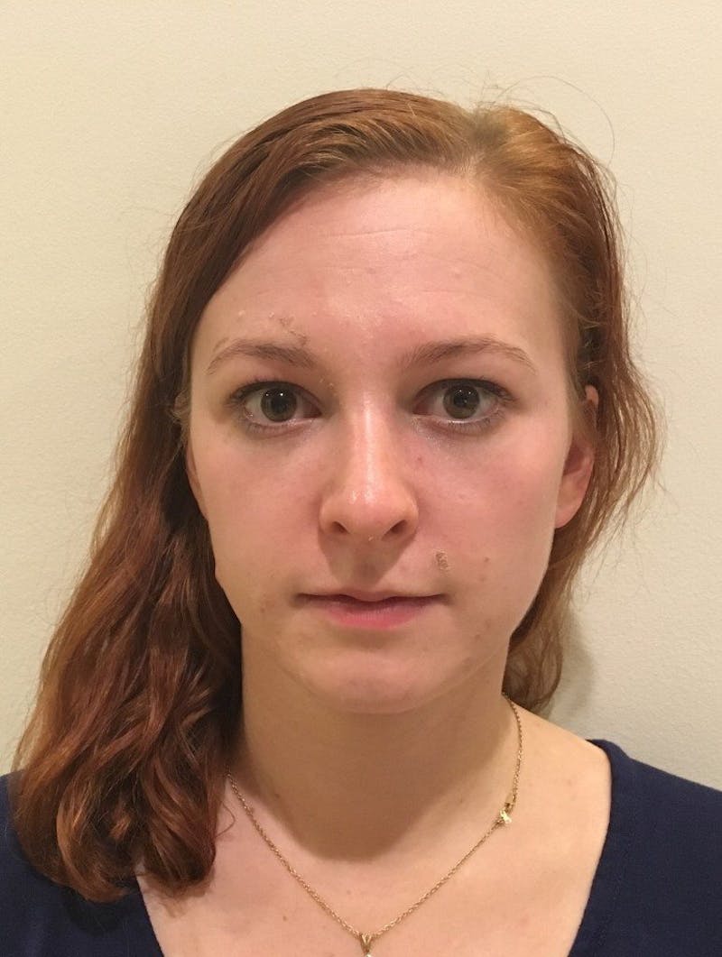 Rhinoplasty Before & After Gallery - Patient 389378 - Image 4