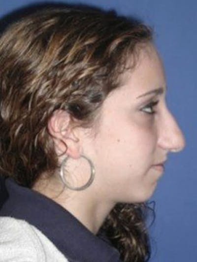 Rhinoplasty Before & After Gallery - Patient 244330 - Image 1