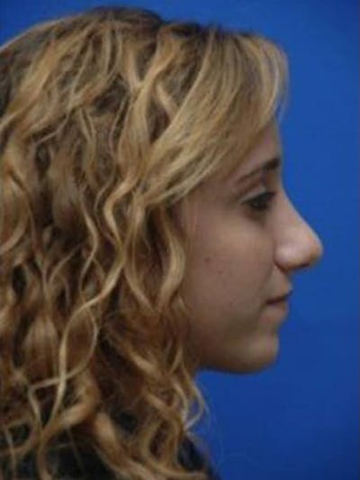 Rhinoplasty Before & After Gallery - Patient 244330 - Image 2
