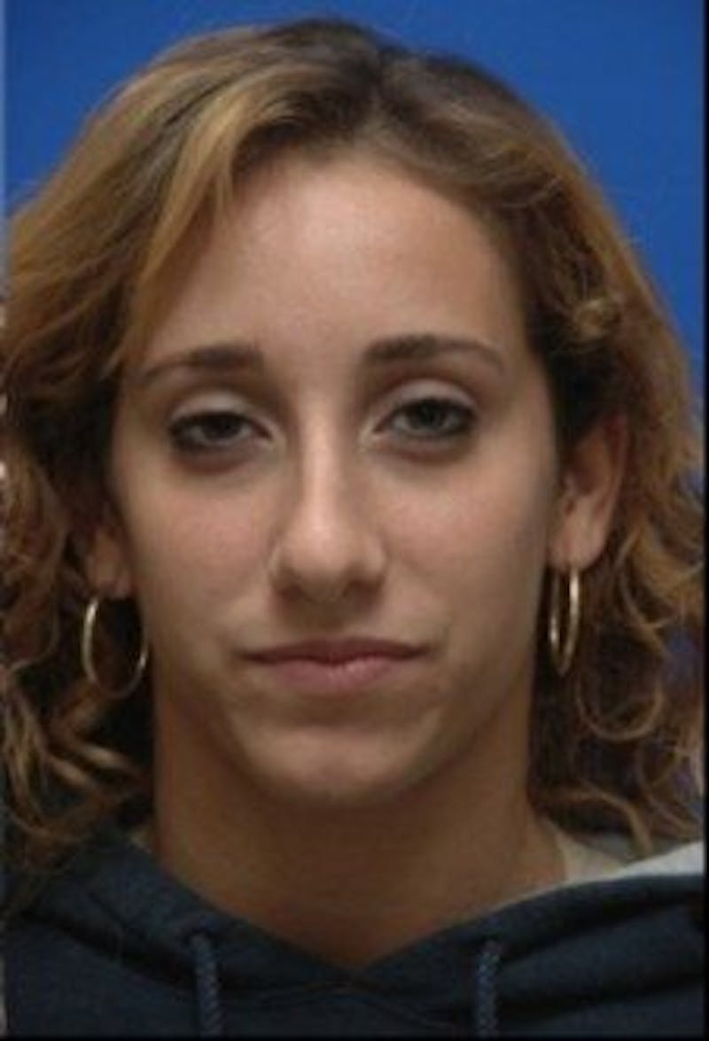 Rhinoplasty Before & After Gallery - Patient 244330 - Image 4