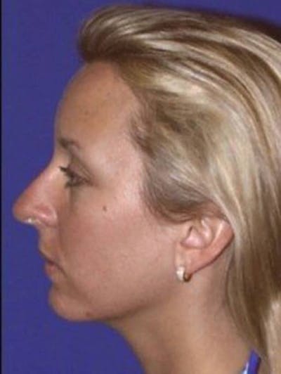 Rhinoplasty Before & After Gallery - Patient 141839 - Image 1