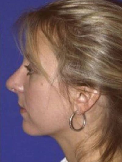 Rhinoplasty Before & After Gallery - Patient 141839 - Image 2
