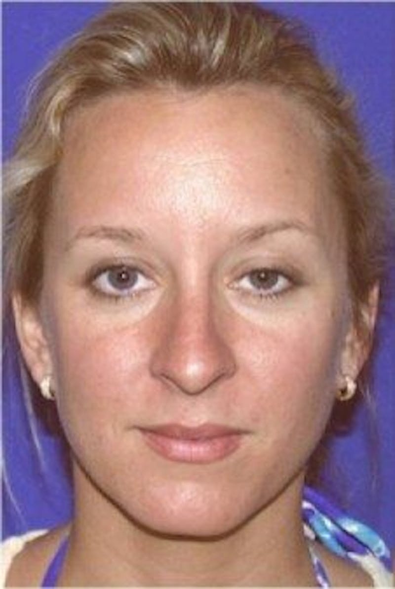 Rhinoplasty Before & After Gallery - Patient 141839 - Image 3