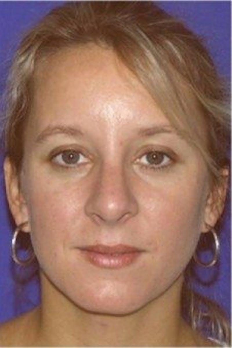 Rhinoplasty Before & After Gallery - Patient 141839 - Image 4
