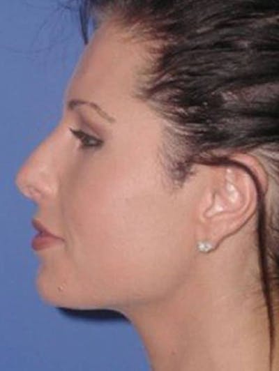 Rhinoplasty Before & After Gallery - Patient 154483 - Image 1