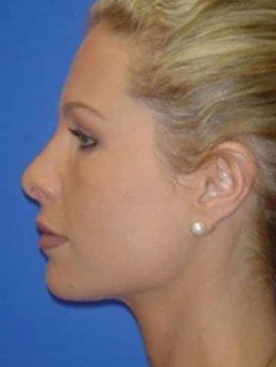 Rhinoplasty Before & After Gallery - Patient 154483 - Image 2