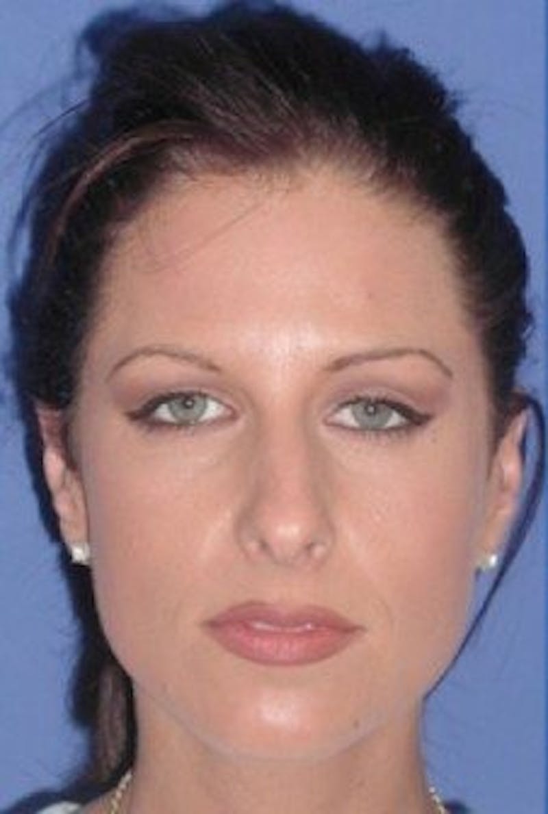 Rhinoplasty Before & After Gallery - Patient 154483 - Image 3
