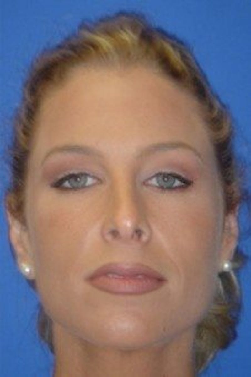 Rhinoplasty Before & After Gallery - Patient 154483 - Image 4