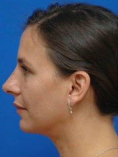 Rhinoplasty Before & After Gallery - Patient 185004 - Image 1