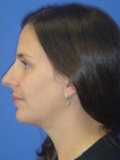Rhinoplasty Before & After Gallery - Patient 185004 - Image 2