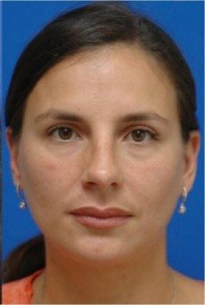 Rhinoplasty Before & After Gallery - Patient 185004 - Image 3