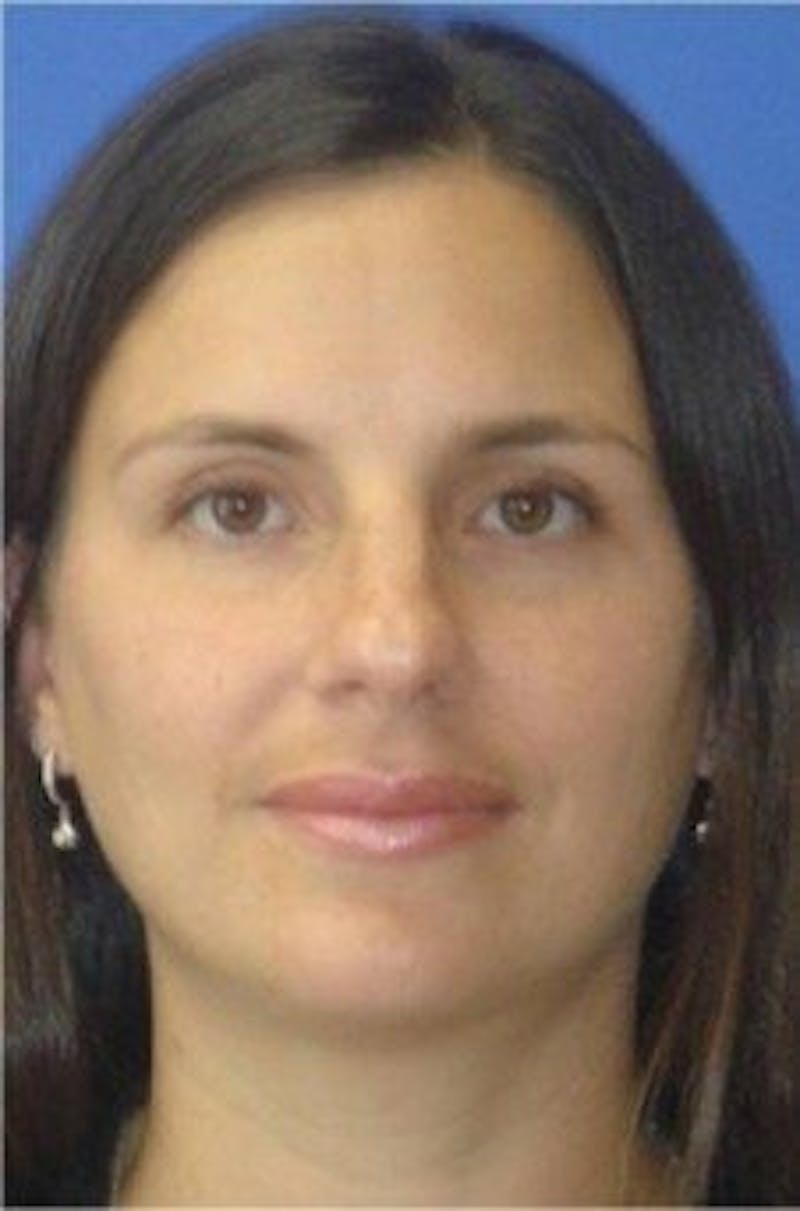 Rhinoplasty Before & After Gallery - Patient 185004 - Image 4