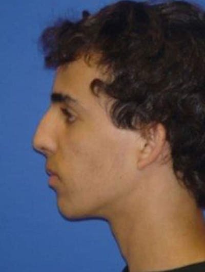 Rhinoplasty Before & After Gallery - Patient 942697 - Image 1