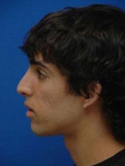 Rhinoplasty Before & After Gallery - Patient 942697 - Image 2