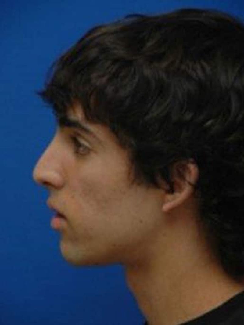 Rhinoplasty Before & After Gallery - Patient 942697 - Image 2