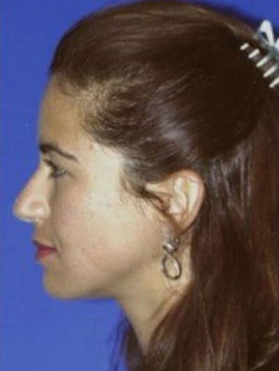 Rhinoplasty Before & After Gallery - Patient 609513 - Image 1