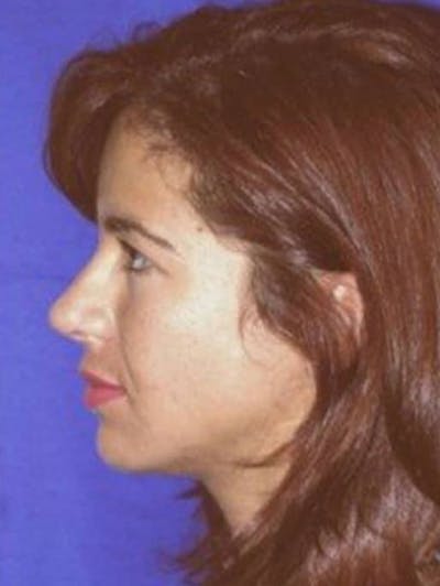 Rhinoplasty Before & After Gallery - Patient 609513 - Image 2