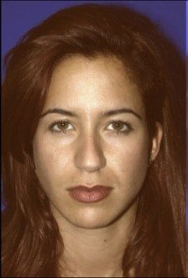 Rhinoplasty Before & After Gallery - Patient 609513 - Image 3