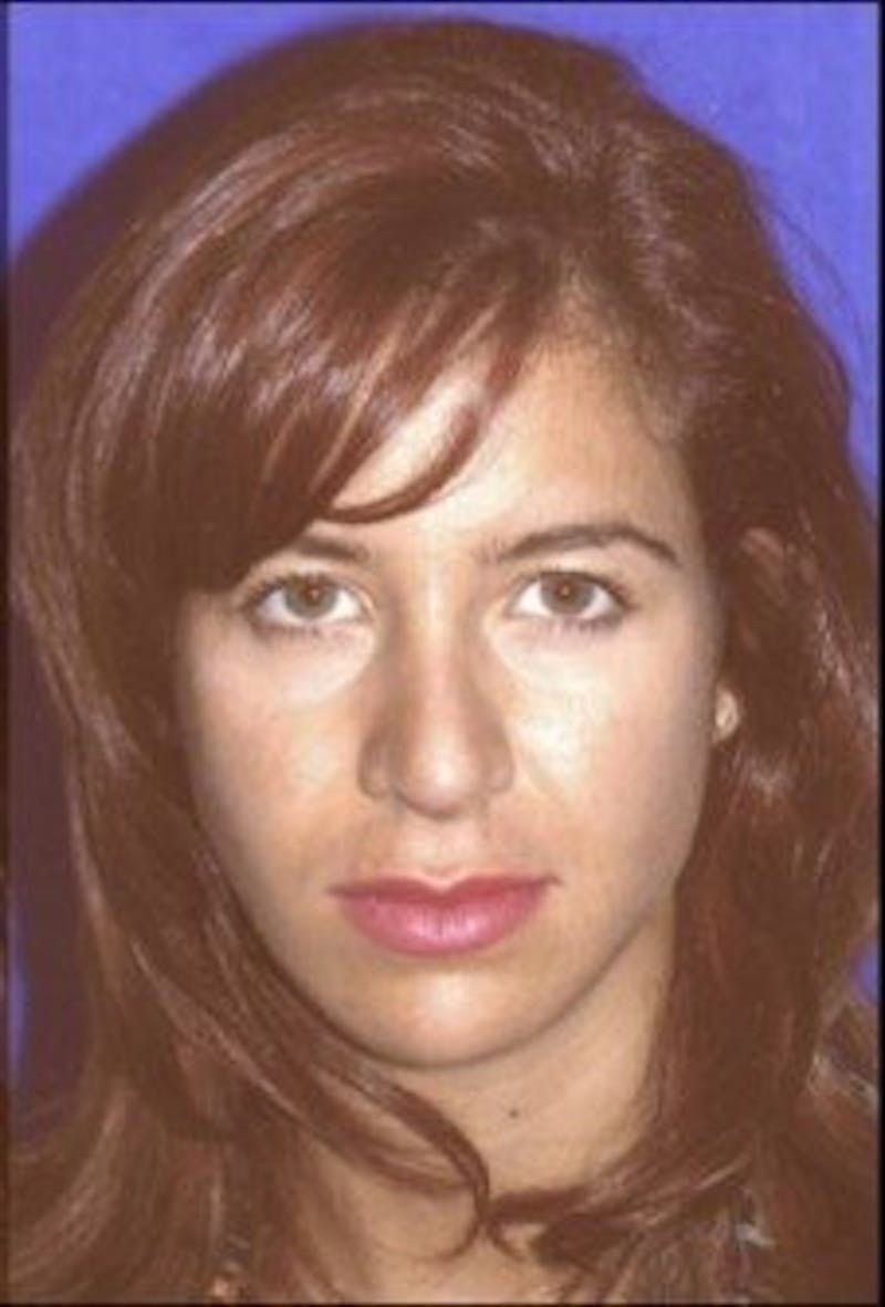 Rhinoplasty Before & After Gallery - Patient 609513 - Image 4