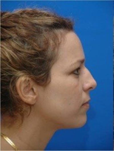 Rhinoplasty Before & After Gallery - Patient 346283 - Image 1