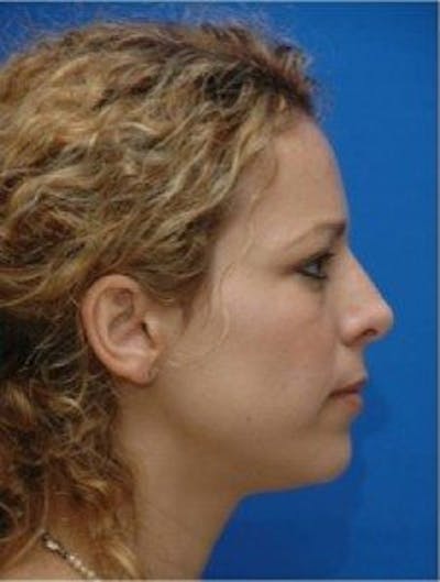 Rhinoplasty Before & After Gallery - Patient 346283 - Image 2