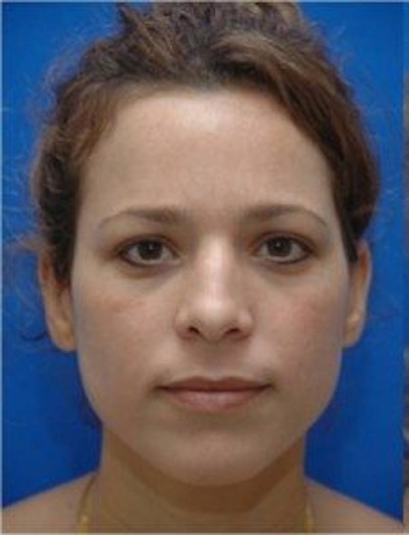 Rhinoplasty Before & After Gallery - Patient 346283 - Image 3