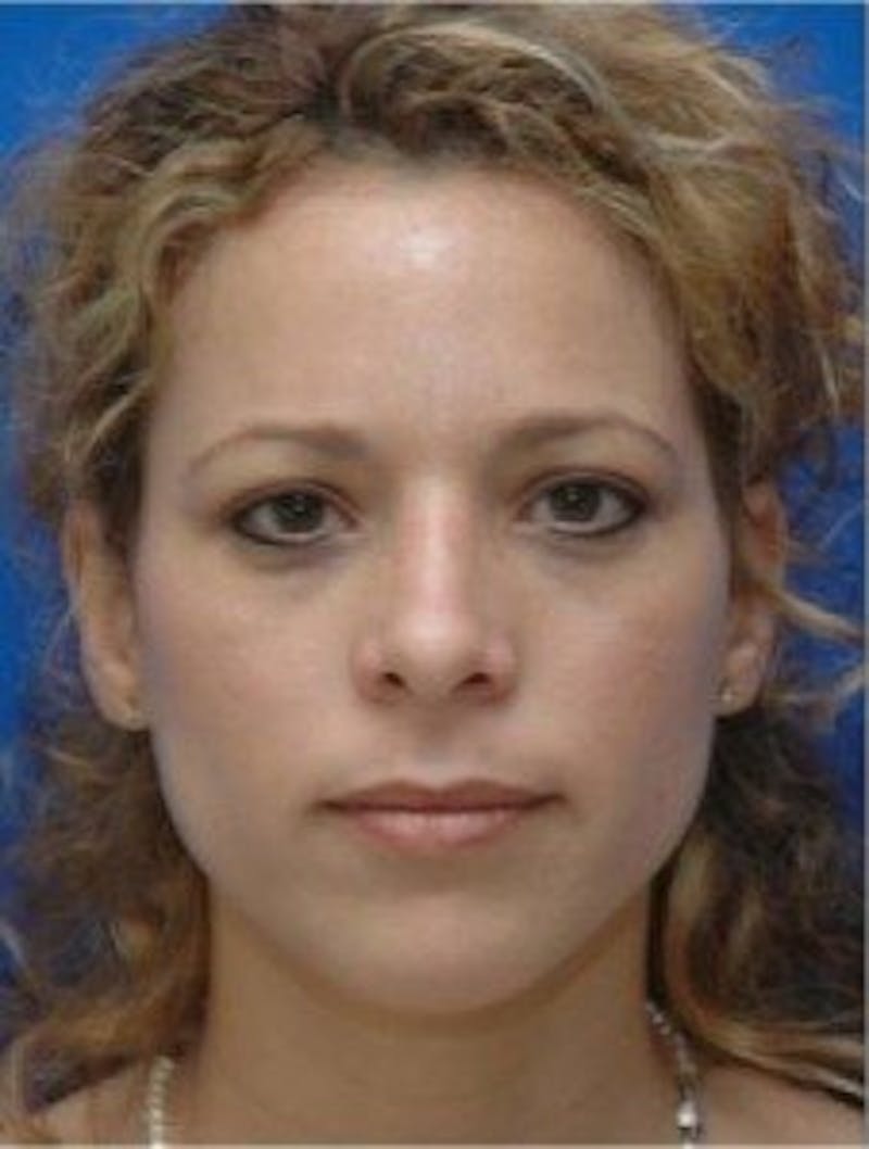 Rhinoplasty Before & After Gallery - Patient 346283 - Image 4