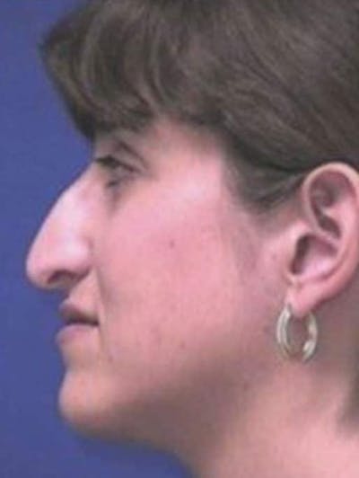 Rhinoplasty Before & After Gallery - Patient 237636 - Image 1