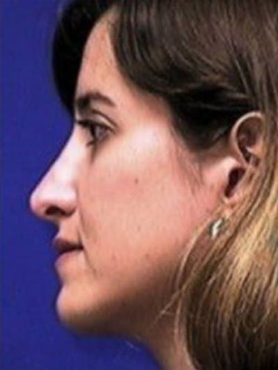 Rhinoplasty Before & After Gallery - Patient 237636 - Image 2