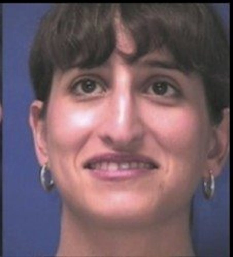 Rhinoplasty Before & After Gallery - Patient 237636 - Image 3