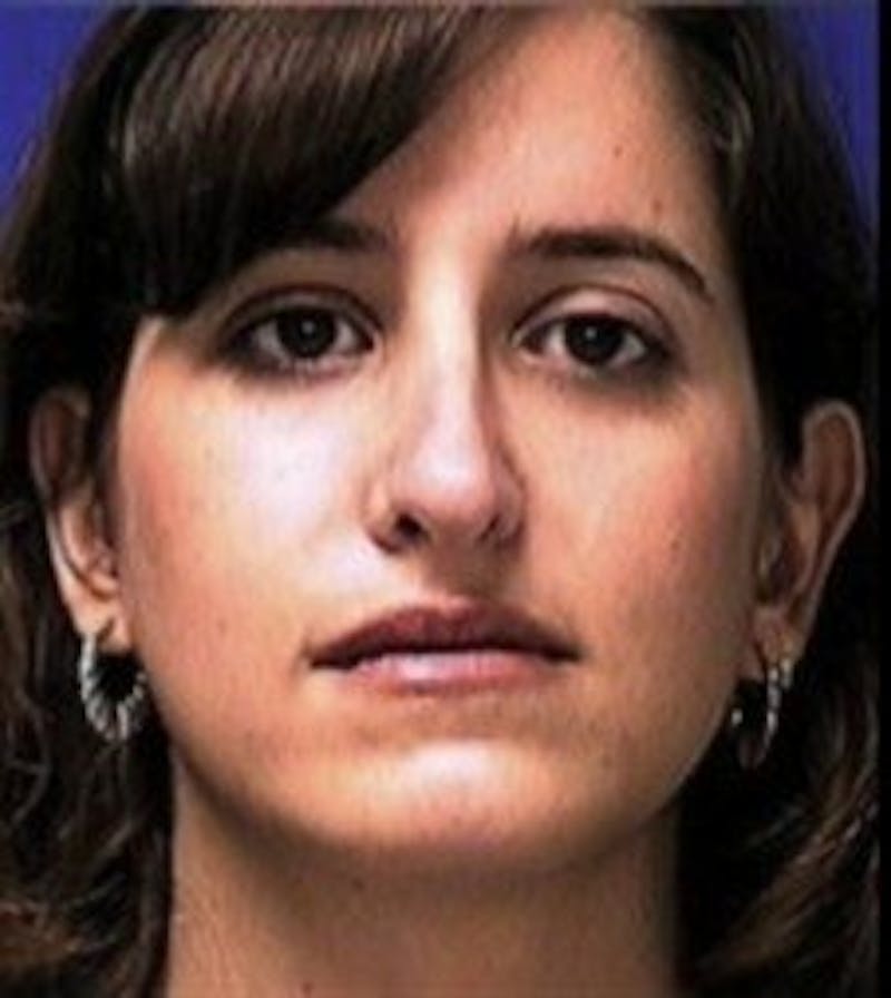 Rhinoplasty Before & After Gallery - Patient 237636 - Image 4