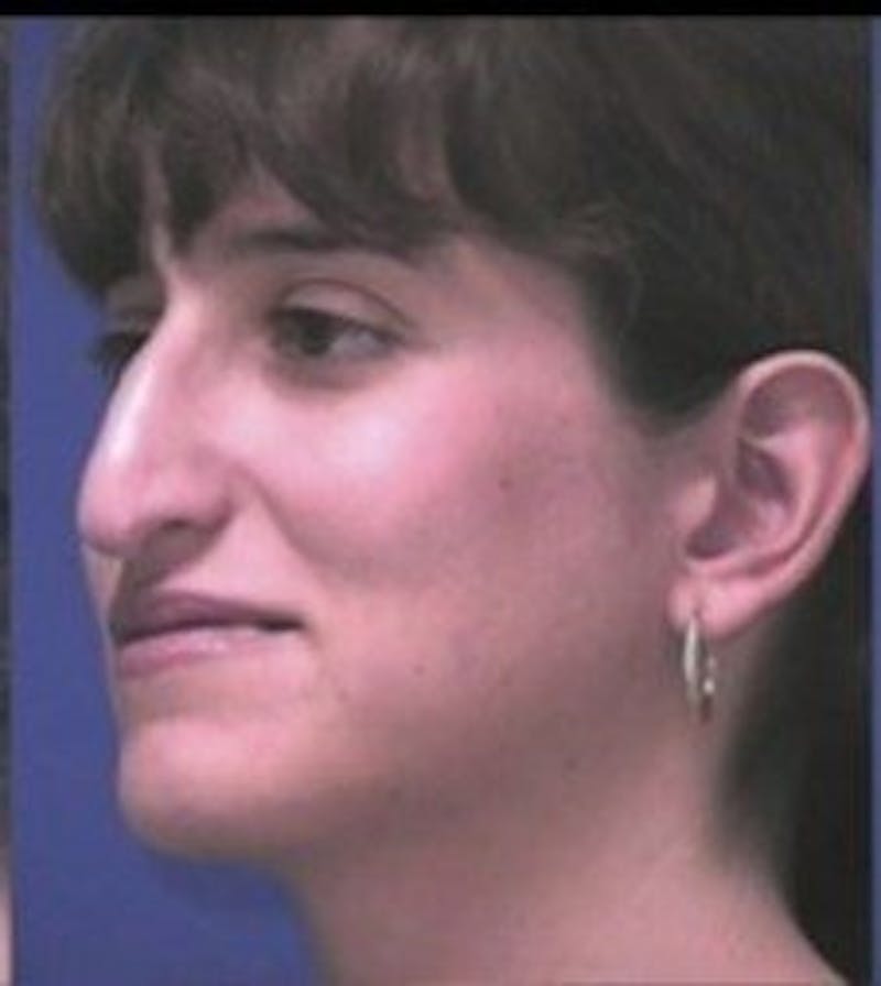Rhinoplasty Before & After Gallery - Patient 237636 - Image 5