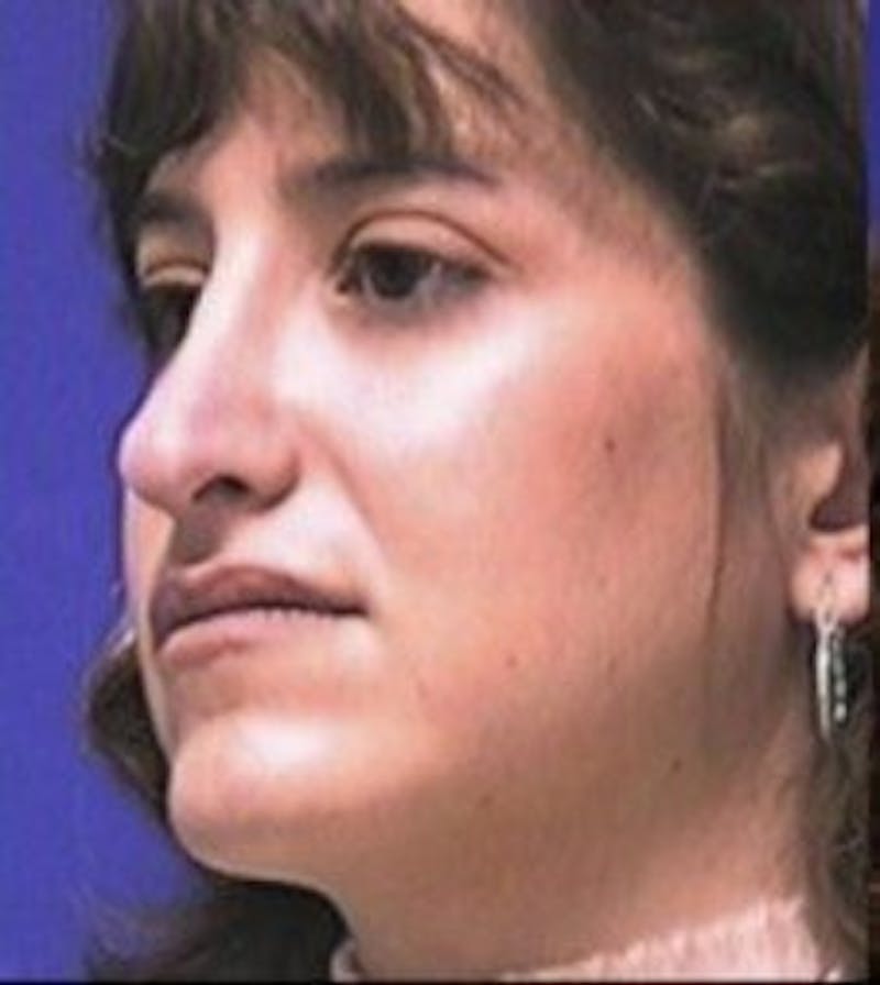 Rhinoplasty Before & After Gallery - Patient 237636 - Image 6