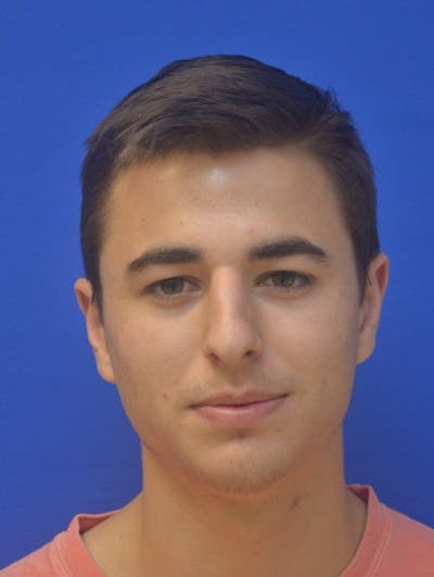 Rhinoplasty Before & After Gallery - Patient 202288 - Image 1