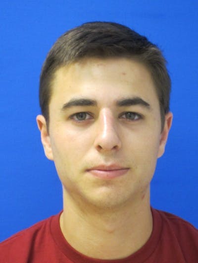 Rhinoplasty Before & After Gallery - Patient 202288 - Image 2