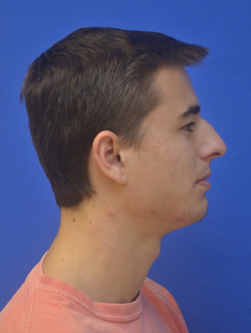 Rhinoplasty Before & After Gallery - Patient 202288 - Image 3