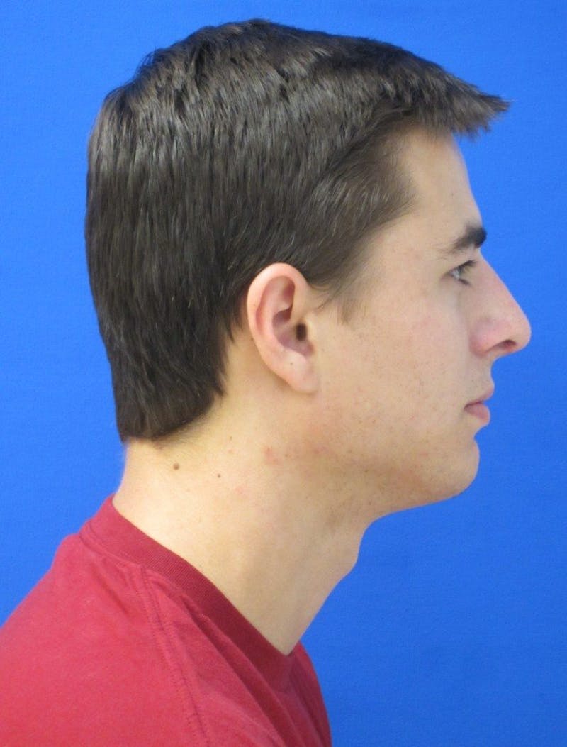Rhinoplasty Before & After Gallery - Patient 202288 - Image 4