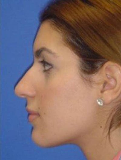 Rhinoplasty Before & After Gallery - Patient 261727 - Image 1