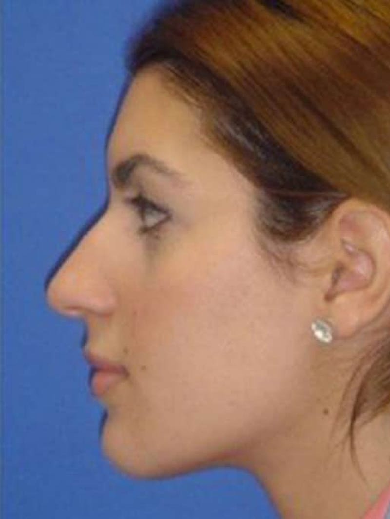 Rhinoplasty Before & After Gallery - Patient 261727 - Image 1