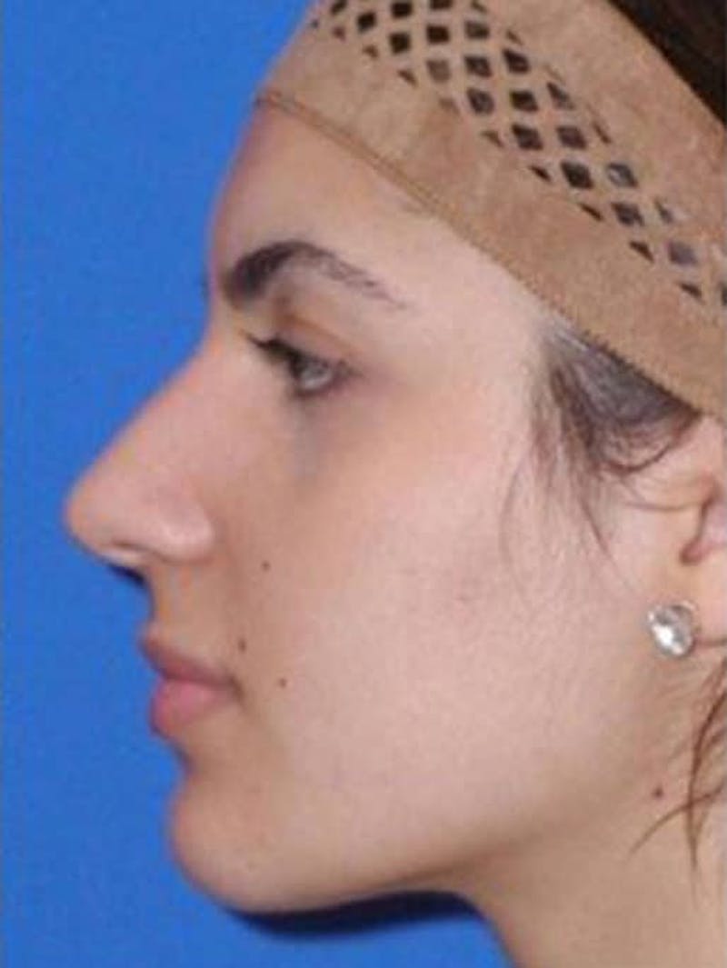 Rhinoplasty Before & After Gallery - Patient 261727 - Image 2