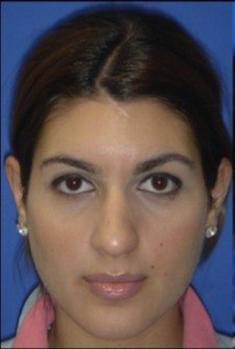 Rhinoplasty Before & After Gallery - Patient 261727 - Image 3