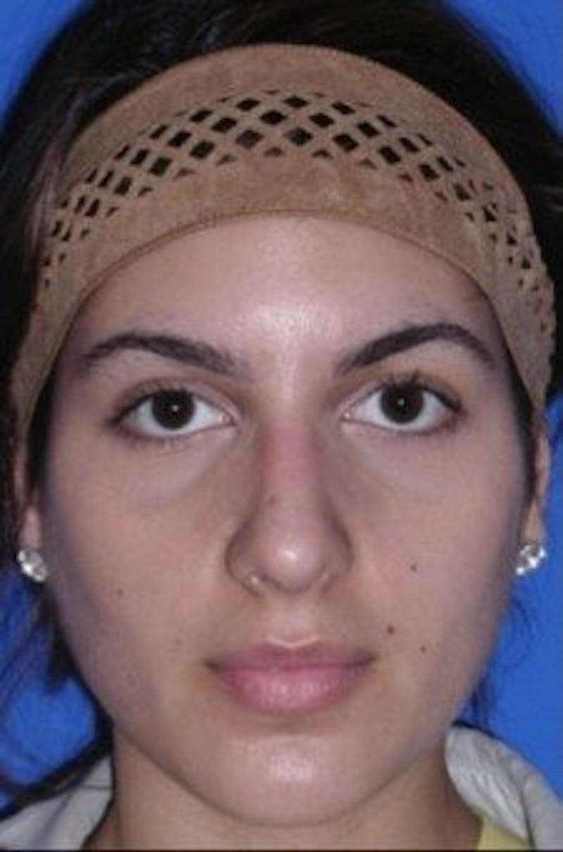 Rhinoplasty Before & After Gallery - Patient 261727 - Image 4
