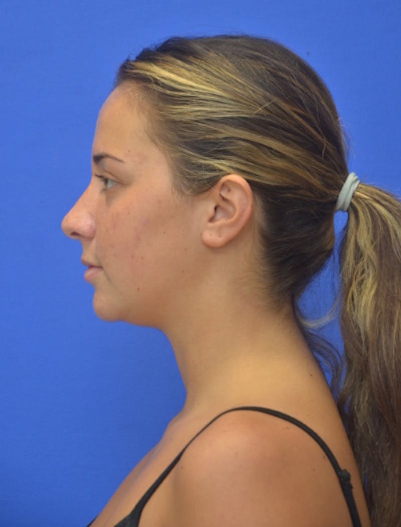 Neck Liposuction Before & After Gallery - Patient 549734 - Image 1